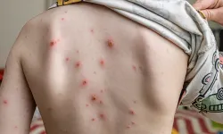 Alanya’da suçiçeği vakaları artıyor: Okullar için uyarı