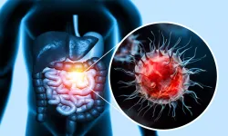 Gençlerde kolorektal kanser artışta