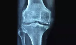 Sessiz ilerleyen tehlike: Osteoporoz kırıkla ortaya çıkıyor