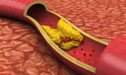 Uzmandan kolesterol uyarısı: Doğru beslenme kalp riskini azaltıyor