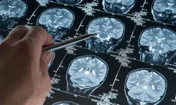 Alzheimer için kritik bulgular: Hastalık yıllar öncesinden başlıyor