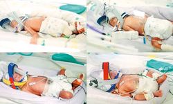 15 milyonda bir görülen tek yumurta dördüzleri doğdu