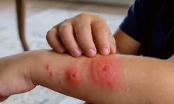 Sivrisinek ısırıklarına dikkat: Uzmanından Batı Nil virüsü uyarısı