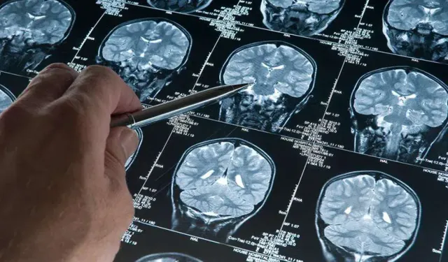 Alzheimer için kritik bulgular: Hastalık yıllar öncesinden başlıyor