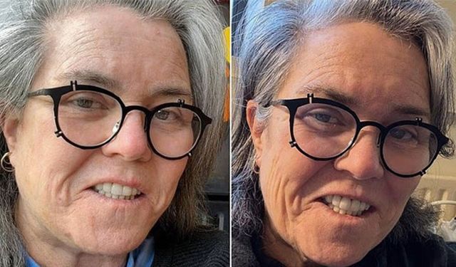 Feminizme ihanet dediği yüz germe ameliyatını yaptırdı