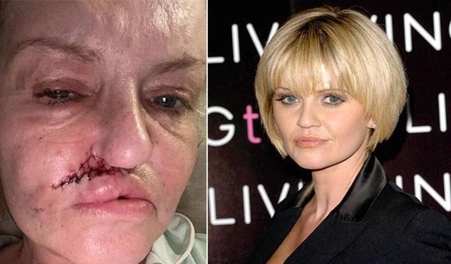 Oyuncu Danniella Westbrook 18 ayda altı ameliyat geçirecek