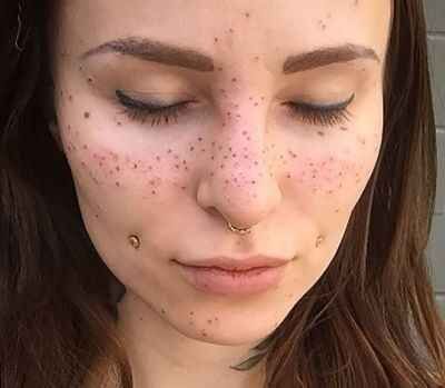 Son moda estetik çılgınlığı!