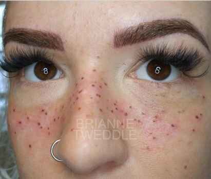 Son moda estetik çılgınlığı!