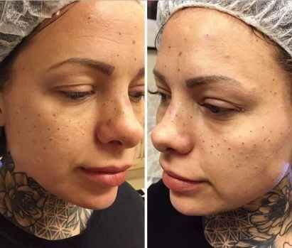 Son moda estetik çılgınlığı!