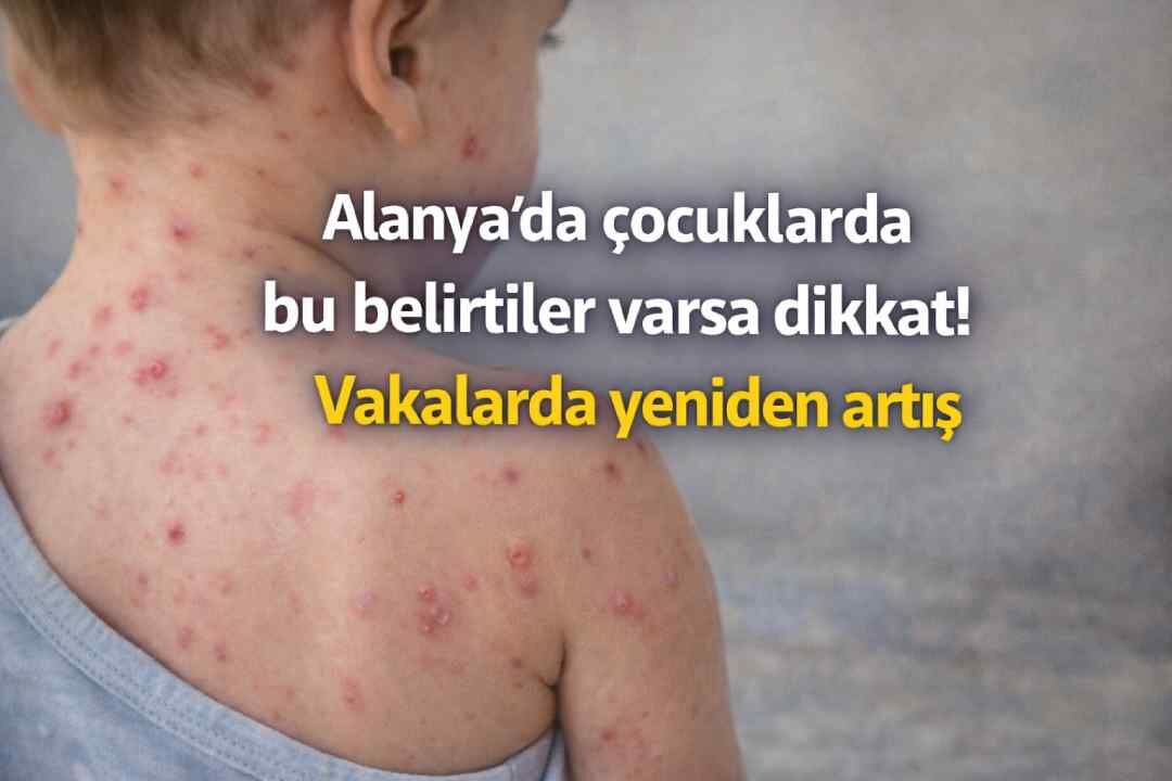Alanya'da çocuklarda bu belirtiler varsa dikkat! Vakalarda yeniden artış